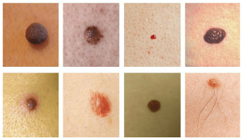 As mais comuns são as manchas na pele é o nevo e o papilomavírus (verrugas)