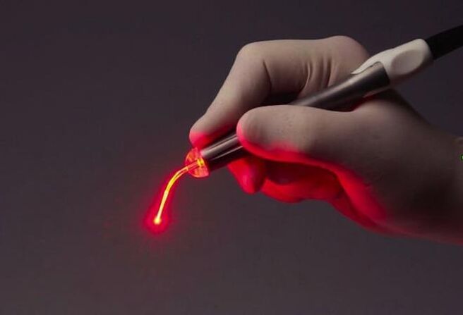 laser de papiloma de garganta