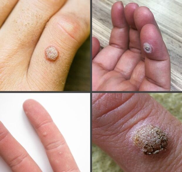 Tipos comuns de verrugas nos dedos