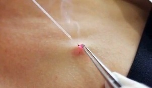 remoção de papilomas no corpo com um laser