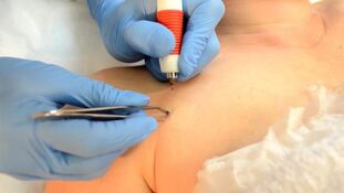 Eletrocoagulação - um método para remover papilomas